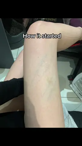 Gotta love dogs, right? #dogs #scratch #bruises #ibruiseeasily #bodyart 