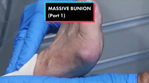 Im back with another massive bunion 👀 #fyp #podiatrist #minimallyinvasivesurgery #TOEronto #minimallyinvasive #bunion #bunions 