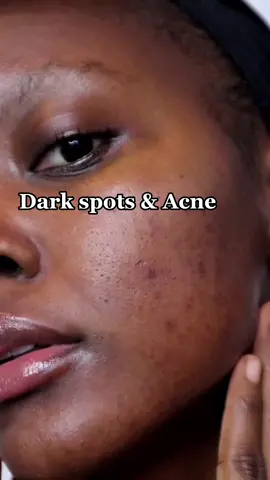 #texturedskin #acnescarstreatment  #skintiktok #SkinCare101 #hyperpigmentation  #largepores #blackgirlskincare #pocskincare
