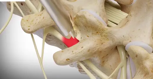 endoscopic #lumbar #foraminotomy #nerves #pain #spine #legs #