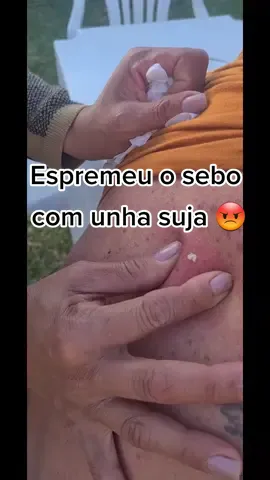 cravo fedido #cravo #fedido #espinha #nojo #fy #foryou #foryoupage