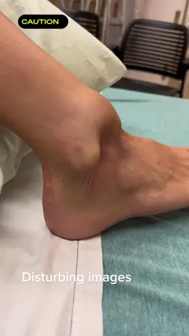 Disturbing images. Sever ankle dislocation with fractures #ankledislocation #medical #hospital #colorado #painful #fractures #anklesurgey 