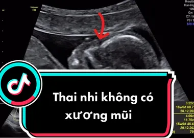 Em bé đi siêu âm không có xương mũi , xét nghiệm N cho kqua con bị hội chứng Dow , chờ thêm kqua chọc ối hi vọng mong manh 🥺 #sieuamanan #dow #sieuamthai #satthuvideongan 