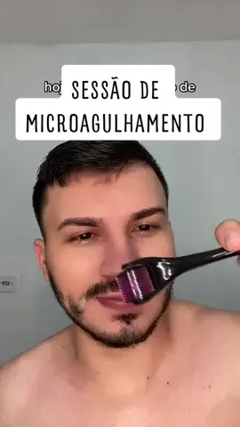 hoje foi dia de sessão de microagulhamento 😬 #dermaroller 