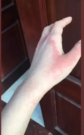 nhìn lại đôi bàn tay ý vẫn thấy bản thân chịu đau giỏi,sưng tấy nứt nẻ nhưng ngày ngày vẫn gội đầu cho khách🙂