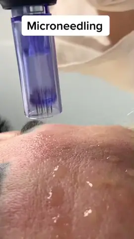 Dermapen  ✨omlazení a zpevnění pleti, vyhlazení jemných vrásek, účinná při léčbě jizev, strií, akné, hyperpigmentace✨ #mikrojehlickovani #dermapen#estetickysalon#salonkrasy#mucroneedling#chemickypeeling 