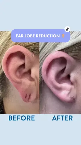 Ear lobe reduction procedure in our iconic London Harley Street clinic 🔥✨ #operation #minorops #earpiercing #fyp #foryoupage #trending #trendingsound #surgeon #tiktoksound #london #harleystreet 