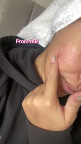 My skin transformation after going back and fourth with dermatologists and spending $$$ on products ✨ #skintransformation #acne #hormonalacne #skincaretips 