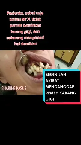 Karang gigi jangan dianggap remeh ygy karena merupakan penyebab utama masalah dirongga mulut loh. siapa yang belum scalling 6 bulan terakhir 😱#fypシ #kesehatan #fypdongggggggg #foryoupageage #fyp #fypシ゚viral #VoiceEffects 