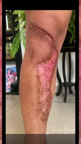 Mostre essa transformação para alguém que tem cicatrizes! #RockinRio2022 #foryoupage #fyp #fypシ #scartattoo #scartattoocoverup #coberturadecicatriz #plasticsurgery #cirugiaplastica #tiktok #viraltiktok #AnimaisNoTikTok #tattoo 