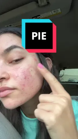 i know time heals all but i want these to fade quicker ☹️ #acne #PIE #postinflammatoryerythema #redness #relatable #fyp #viral 