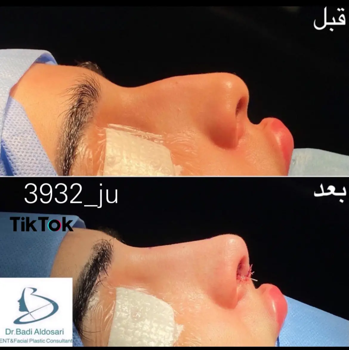 #الرياض #تجميل #تجميل_الأنف #مستشفى_الحبيب #fyp #اكسبلور