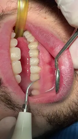 🦷Rimozione tartarto 🦷