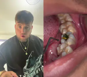 #duet with @Dokter Gigi Tri Putra TOOTH WAS FILLED TO THE BRIM - IG - richardsalesofficial #viral #xyzbca #FYP 