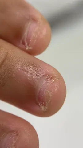 Transformação! ❤️  A parte mais importante de uma unha roída: Preparação perfeita!  #nail #nails #comofazerunhasroidas #unhasroidas #perrenguecomunhas #naildesigner #nailsroidas #unhasdegel #unhasroidasalongadas #audiosemalta 