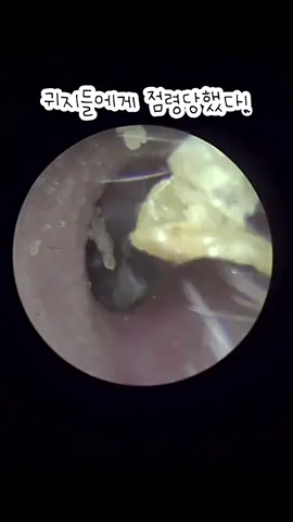 @귀지형 #귀지#귀지제거 #귀파기 #귀파기asmr  #귀청소 #이비인후과 #earwax #earwaxremoval  #asmr