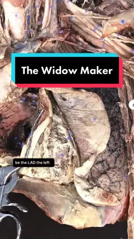 The Widow-Maker Heart Attack is a devastating cardiac event caused by a blockage of the left anterior descending coronary artery (LAD) It causes the left side (the body side pump) of the heart muscle to stop working. Today we will take a look at the anatomy of this condition. #anatomy #heart #widowmaker