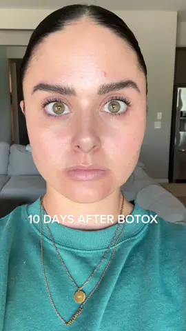 My botox results progression! Kristalclearaesthetics on IG is your girl! 💕 #botox #beauty #filler #skincare #mama 
