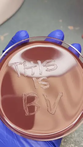 This is BV, ladies!!!! Read more at lastnamevirgo.com #healthcare #health #medicina #medicine #medtech #medtechstudent #medschool #medicaltechnologist #doctor #wellness #healthcareworker #microbiology #scienceexperiments #laboratory #laboratorio #urine #urinalysis #urinarytractinfection #whitebloodcell #redbloodcell #gonorrea #gonorrhea #chlamydia #stdawareness #microscope #microscopio #microscopetiktok #microscopeviews #underthemicroscope #bacterialvaginosistalks #bacterialvaginoisis #bacterialmeningitis #bv 