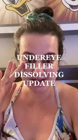 Replying to @merrymerry883 here’s a quick update of how I’m feeling since dissolving my undereye filler! #teartroughfiller #undereyefiller #fillerdissolving #hyaluronidase #hylenex 
