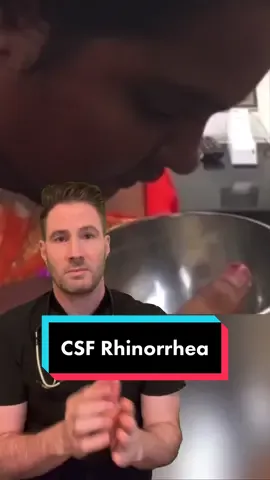 Cerebrospinal fluid (CSF) rhinorrhea is a condition where the fluid that surrounds the brain leaks into the nose and sinuses. Head trauma, surgery, or even birth defects can make a hole in the membranes that hold this fluid. It then leaks into your nose or ear, causing a watery, runny nose. CSF rhinorrhea is very rare. #skullfracture #csf #doctor #trauma #drjoe #drjoemd 