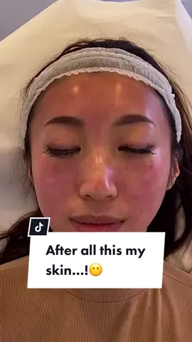 Damnnn 📍Aibeauty #london #skincare #pores #microneedling 