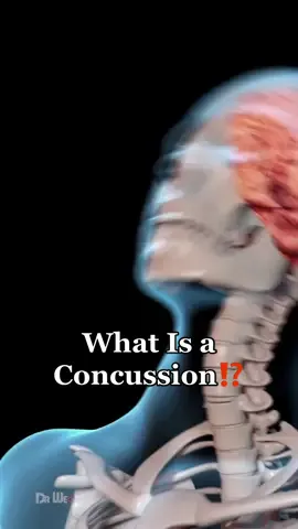 What Happens When You Have a Concussion #animation #concussion #braininjury #head #health 