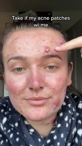 Btw this is not a ad it only says that because I’ve linked the product to this video, these patches are amazing honestly🫶🏼 #acnepositivity #acne #acnepatches #acneskin #skincare #acnepatch 
