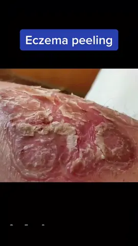 Eczema peeling and scractching, sooo satisfying #eczema #eczematreatment #eczemaawareness #eczemaremoval#skincare #satisfying #dermatologist #rash #viral #fyp #flakes #itching #tiktok #sua 