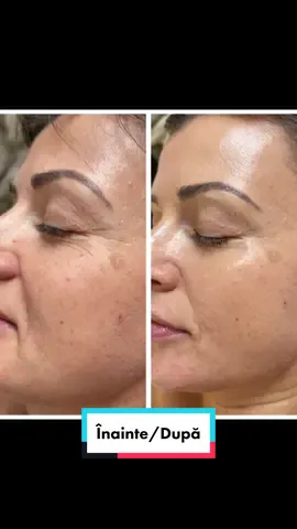 Peeling Chimic pentru riduri Wrinkle Lift de la @IMAGE Skincare. #chemicalpeel #imageskincare #TikTokBeauty #beforeandafter 