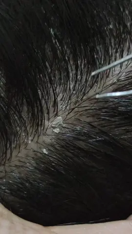 Relaxing dandruff removal #oddlysatisfying #relaxing #satisfying #dandruffremovel #dandruffremoval #dandruff #deepsleep #deepsleepmusic #asmrvideo #asmr #soothing #calming #extraction #removal #scalpscratching #scalp #sensitivecontent⚠️ #fyp #fypシ 