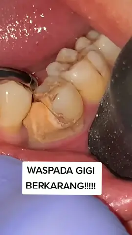 #gigikuning #tipsgigiputih #pastagigicharcoalsr12 #pastagigicharcoalsr12herbal #AQUADULU #solusigigiputih #gigiberkarang 