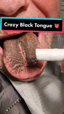 Crazy Black tongue! What is wrong here? Can this be wiped off ❓❓❓#blacktongue  #tongue #LearnOnTikTok #fyp #foryoupage 