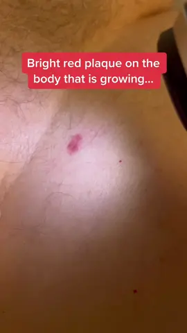 See your dermatologist for changing/growing spots on the body and #wearyoursunscreen #dermatology #drsugaiskincare #basalcellcarcinoma #skincancer 