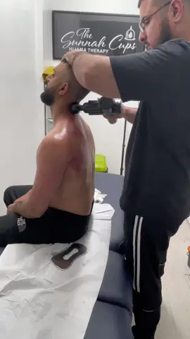 Long distance driver neck pain release. #cupping #cuppingmassagetherapy #fyp #massagetherapy #chiropractic 