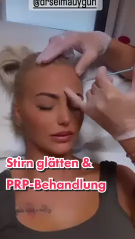 Die tolle @Anita Latifi hat sich von mir behandeln lassen. Wir haben ihre Stirn mit Botox behandelt und im Anschluss eine PRP-Behandlung durchgeführt. #vorhernachher #schönheit #drselmauygun #faltenbehandlung 