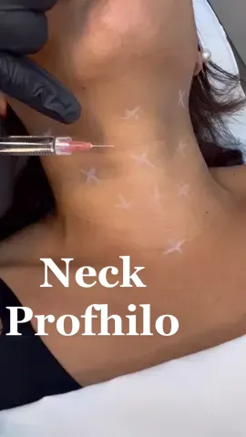 ✨ Say HELLO to Neck PROFHILO ✨ One of my favourite injectable skin treatments in clinic that gives your skin rejuvenation, plumpness & youthfulness! As you can see it’s great for that ‘turkey neck’ and adored by all HA-Derma Profhilo UK @innov.aesthetics  . . . #pdothreads #cogthreadlift #nonsurgicalfacelift #facelift #botox #fillers #advancedaesthetics #photooftheday #instadaily #picoftheday #skincare #beauty #makeup #brasileirosemlondres #glasgowbeauty #harminozacaofacial #skincaretips #SelfCare #aesthetics  #glowingskin #antiaging #harmonizacao #lipfiller #healthyskin #instagood #facial #serum #acne #makeupartist