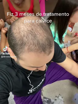 Resultado do meu tratamento de 3 meses para calvice. Fazia também microagulhamento. Achei que cresceu bastante e vou continuar o tratamento 💸 #tiktok #brasil #minoxidil #calvicie #cabelos #hairtok #hairtutorial #StumbleWheels #meuladofilhodamae #