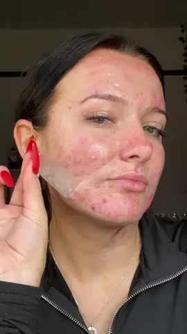 Acne patches #acnepositivity #acnepatch #acneskin #acneproneskin #acne #skincare #texturedskin #acneisnormal #acnefighter @@letsfazit