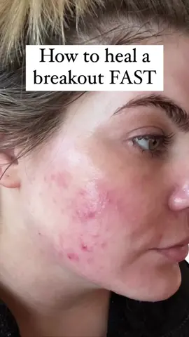 These skincare products helped my acne SO much ❤️ if you’re struggling they’re worth a shot! #acne #skincareroutine 