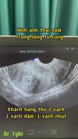 Các mom lấy vía mèo con bỏ bụng nào, hình ảnh túi thai sớm đã đậu trong lòng tử cung #bssanphukhoa #bacsiphukhoa #bacsi #drtybi #thaisom 