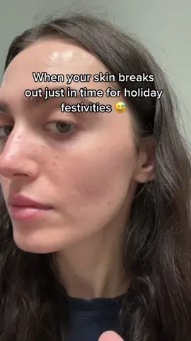 It’s like my skin purposely acts up when I need it to look it’s best 😭 #acne #acnefighter #acneskin #acnecheck #acneskincare #acneproneskin #acnepositivity #skin 
