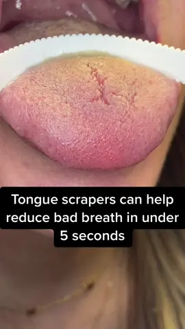Tongue scrapers can reduce bad breath in under 5 seconds #dentalasmr  #badbreathtreatment #howtogetridofbadbreath #dmdomg #tongueanatomy #tonguescraper #dentalcleaning #dentist 