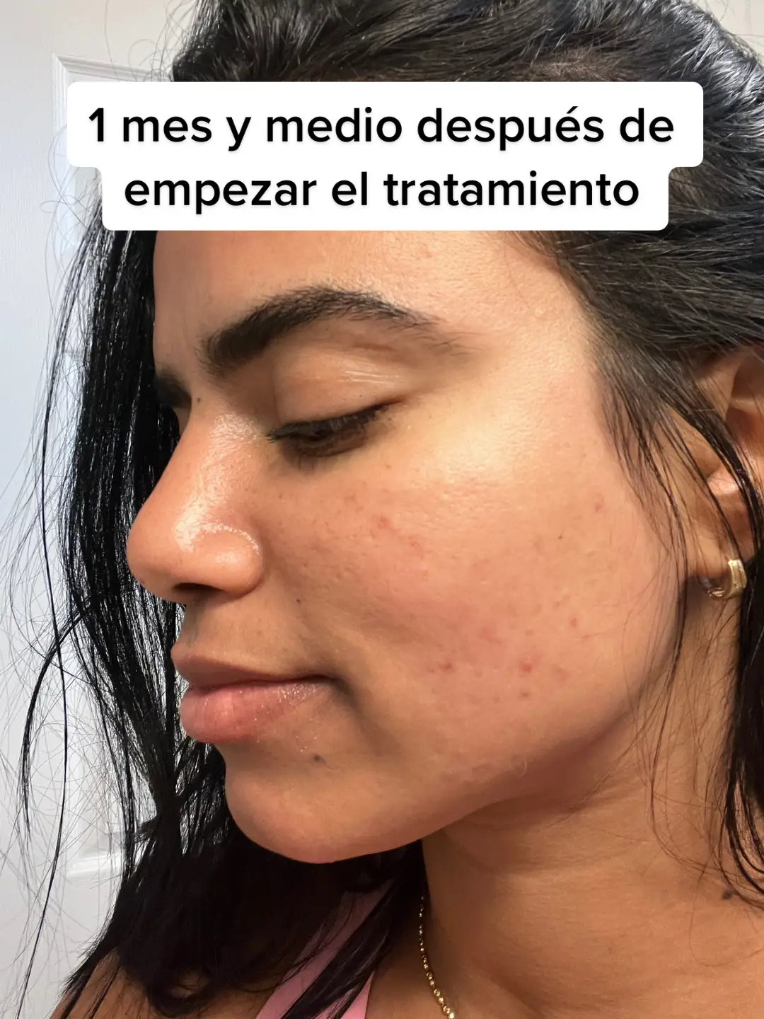 Un mes y medio de tratamiento. Ya estoy viendo mejoras. Les hare una actualización mas adelante a ver como sigo🥹 #acne #tratamiento #aklief #akliefacnetreatment #randely29 #randelylife 