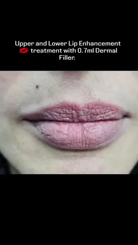 Upper and Lower Lip Enhancement 💋 treatment with 0.7ml Dermal Filler. 