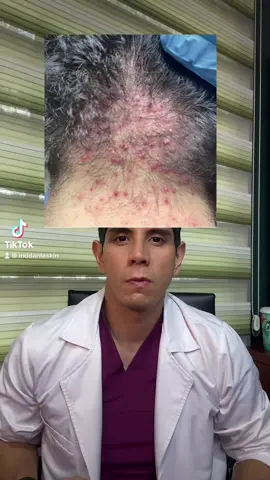 #acne #acnetreatment #foliculitis #foliculitisdelanuca #foliculitisgluteos #derm🐱 #derm🐱 #skincare #dermatologo 