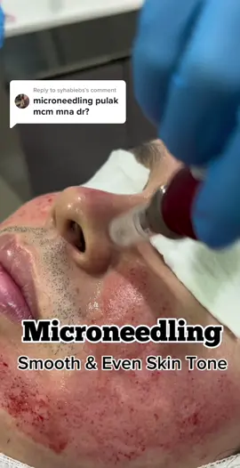 Replying to @syhabiebs Proses rawatan microneedling untuk parut dalam