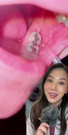 Dentistry Explained Episode 87 | Wisdom teeth can leave behind holes in the gums that will eventually fill back in but need to be kept nice and clean!  Cc: @L  #wisdomteeth  