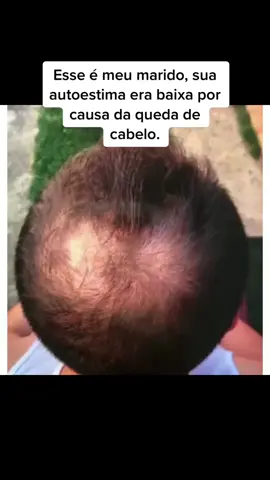 RECADO DO CLINTE!!! Esse produto se chama 100queda e é o queridinho para o tratamento da calvice, uma tecnologia importada que pausa a queda de cabelo e ajuda no crescimento de novos folículo capilares, aqui está a oportunidade para renovar sua autoestima #fypシ #calvice #100quedadecabelo #100queda #calvicemasculina 