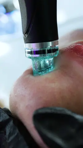 Conoce el paso #2 de Hydrafacial: las extracciones de las impurezas de los poros mediante una suave succión indolora✨#HydraFacial #HydraFacialNation